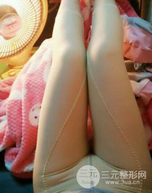 大腿抽脂案例 大腿抽脂前后对比图