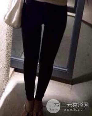 大腿抽脂案例 大腿抽脂前后对比图