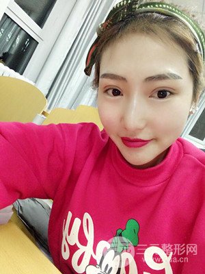 激光脱毛前后照片分享，真实案例~