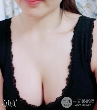 本人自体抽脂隆胸手术果很好价格案例