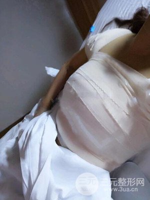 假体隆胸真实案例分享并附上前后对比图片——襄阳维多利亚张世莲医生做的