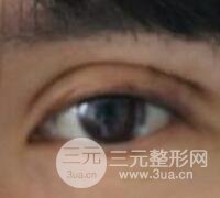 割双眼皮失败变几层眼皮成功修复价格和案例分享