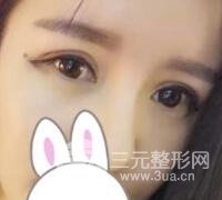 割双眼皮失败变几层眼皮成功修复价格和案例分享