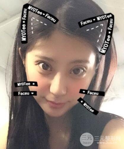 成都娇点李竞割双眼皮价格和案例