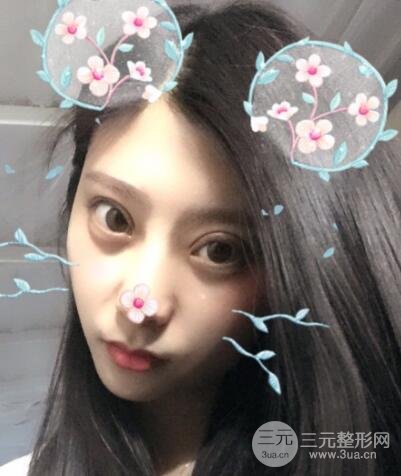 成都娇点李竞割双眼皮价格和案例