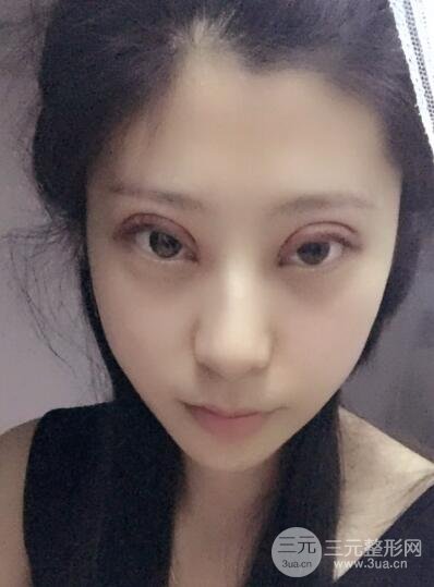 成都娇点李竞割双眼皮价格和案例