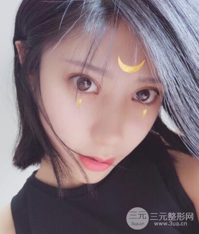 成都娇点李竞割双眼皮价格和案例