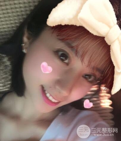 成都娇点李竞割双眼皮价格和案例