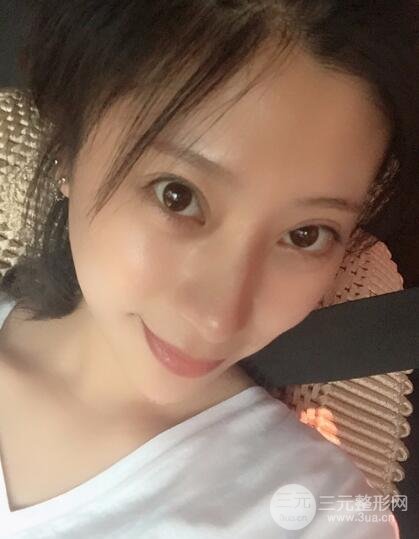 成都娇点李竞割双眼皮价格和案例