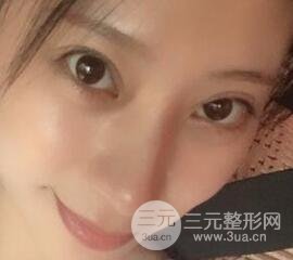 成都娇点李竞割双眼皮价格和案例