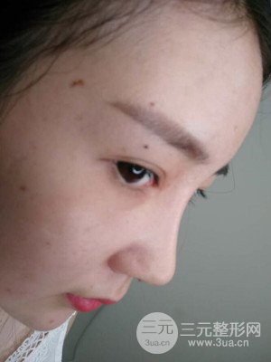 隆鼻整形案例日记分享：附上前后对比图片