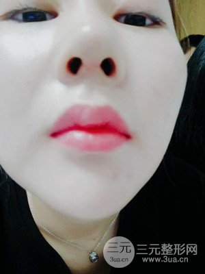 隆鼻整形案例日记分享：附上前后对比图片