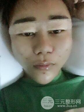 切开双眼皮+自体脂肪填充全脸真实案例分享，并附上前后对比图片~