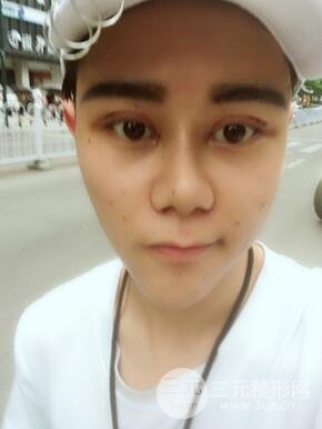 切开双眼皮+自体脂肪填充全脸真实案例分享，并附上前后对比图片~