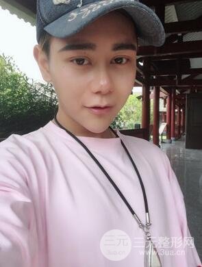 切开双眼皮+自体脂肪填充全脸真实案例分享，并附上前后对比图片~