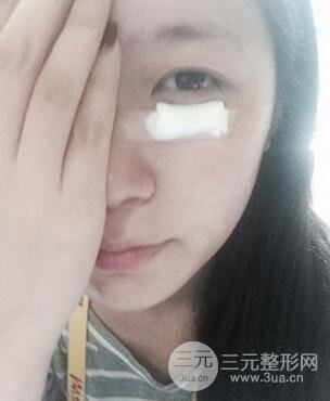 内切祛眼袋手术真实案例，并附上前后对比图片