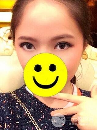 内切祛眼袋手术真实案例，并附上前后对比图片