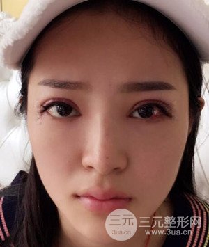 武汉叶子叶飞医生给我做的切开双眼皮手术，分享一下前后对比图