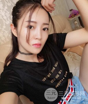 武汉叶子叶飞医生给我做的切开双眼皮手术，分享一下前后对比图