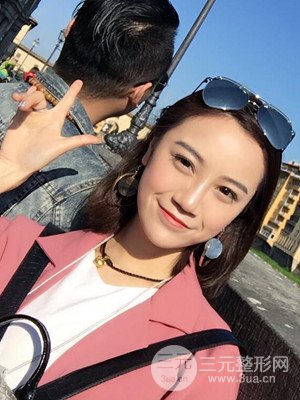 假体隆鼻+耳软骨垫鼻尖真实案例，并附上前后对比图~