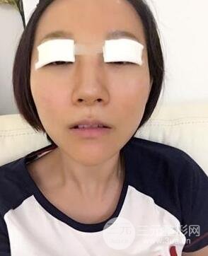武汉叶子竺湘云给我做的切开双眼皮手术，分享一下前后对比图片