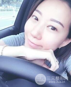 武汉叶子竺湘云给我做的切开双眼皮手术，分享一下前后对比图片