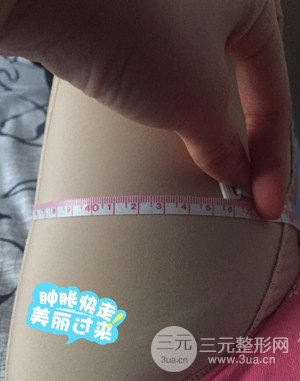 大腿吸脂前后对比图以及恢复过程分享——武汉叶子竺湘云医生做的