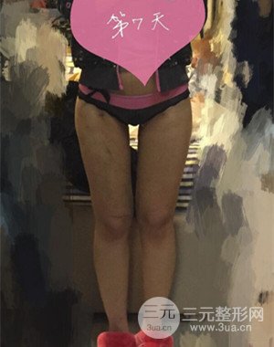 大腿吸脂前后对比图以及恢复过程分享——武汉叶子竺湘云医生做的