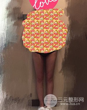 大腿吸脂前后对比图以及恢复过程分享——武汉叶子竺湘云医生做的