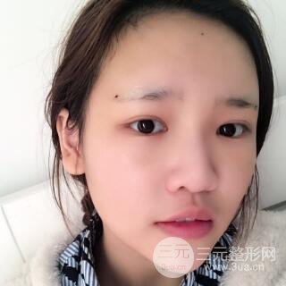 成都娇点整容医院李竞做全脸脂肪填充案例