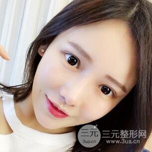 成都娇点整容医院李竞做全脸脂肪填充案例