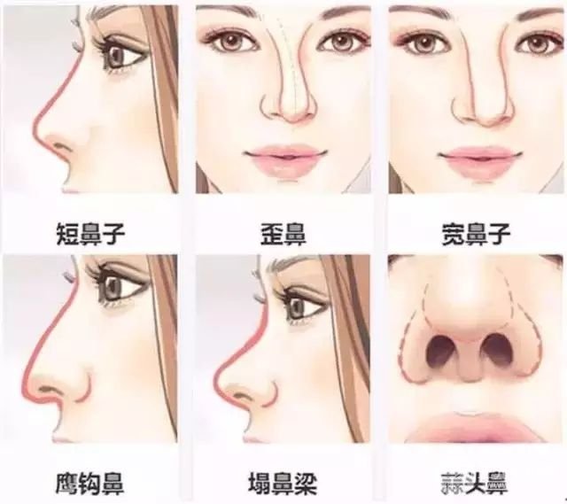 自体脂肪隆鼻多少钱?维持多长时间?