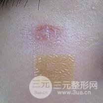 激光祛疤非手术真实果图案例