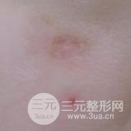 激光祛疤非手术真实果图案例