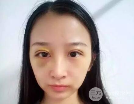 武汉天申朱天申切开双眼皮真实案例，附上前后对比图片