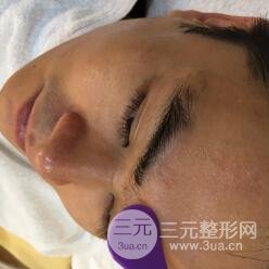 男士高强度聚焦超声面b提升微整形真实案例