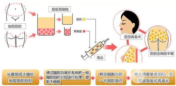 北京东方和谐医院专家谈自体脂肪填充的利弊？有害吗？