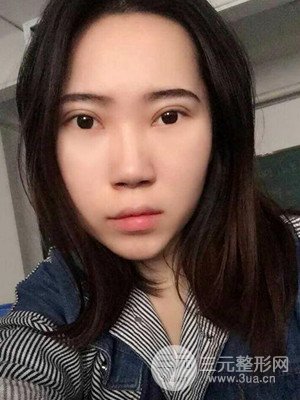 内切祛眼袋手术真实案例，武汉天申胡丽医生做的