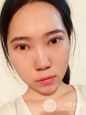 内切祛眼袋手术真实案例，武汉天申胡丽医生做的