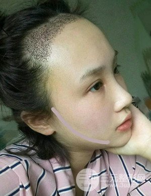 武汉天申胡丽医生发际线种植真实案例，并附上前后对比图片