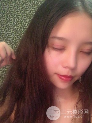 　全切双眼皮真实案例分享，武汉一美汪国民医生做的
