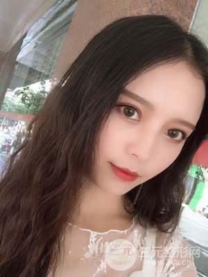 　全切双眼皮真实案例分享，武汉一美汪国民医生做的