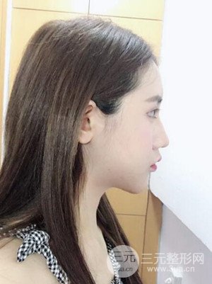 武汉一美汪国民医生做的面部吸脂【案例】，分享一下前后对比图片