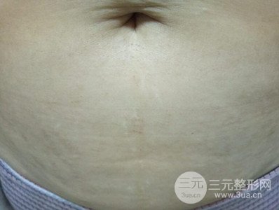 武汉一美王朝晖激光去妊娠纹真实案例，并附上前后对比图片