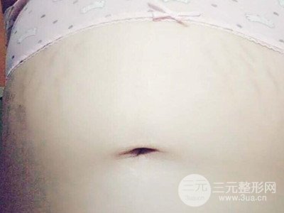 武汉一美王朝晖激光去妊娠纹真实案例，并附上前后对比图片
