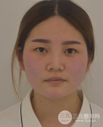 全切开双眼皮价格和恢复过程对比图片