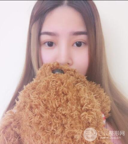 全切开双眼皮价格和恢复过程对比图片