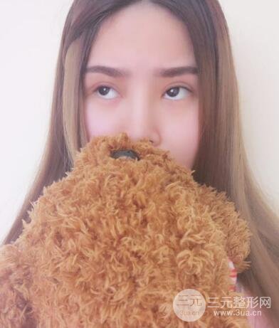 全切开双眼皮价格和恢复过程对比图片