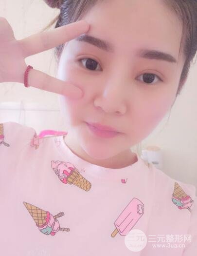 全切开双眼皮价格和恢复过程对比图片