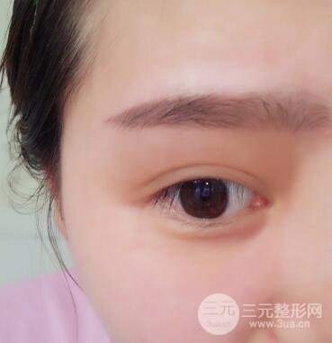 全切开双眼皮价格和恢复过程对比图片